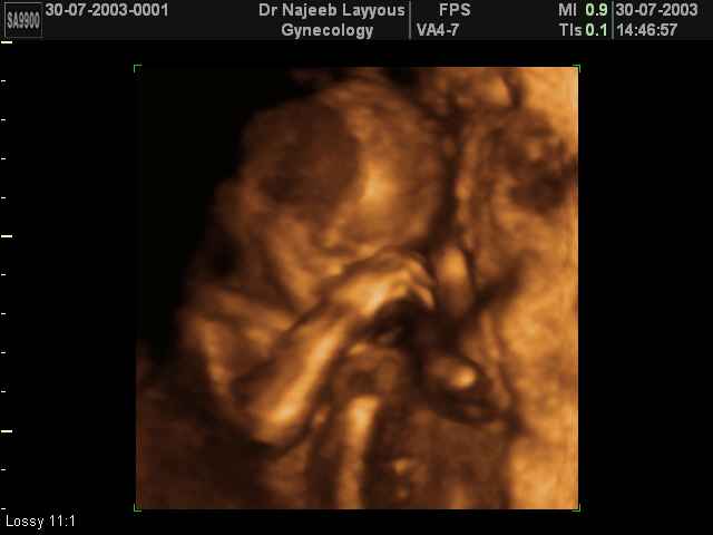 3D Second Trimester