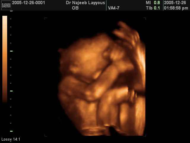 3D Second Trimester